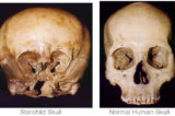 Starchild Skull vs human skull Starchild Skull. Alien-human Hybrid?
